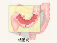 泉州到哪里治疗结肠炎比较好