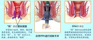 痔疮的不错治疗方法吃什么药