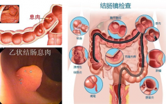 泉州混合痔的病因