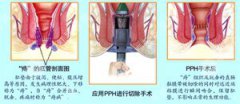 泉州市什么是混合痔？_混合痔百