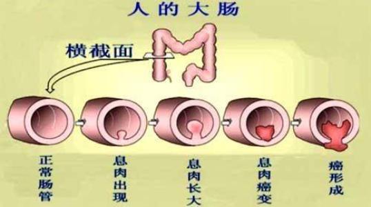 脱肛的不错之类方法