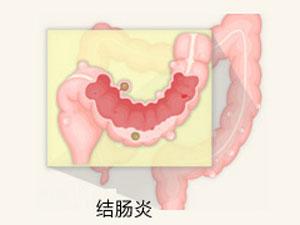 泉州治疗结肠炎要多少费用