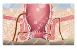 泉州治肛瘘哪家医院比较专业