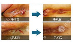 泉州治肛瘘哪家医院比较专业